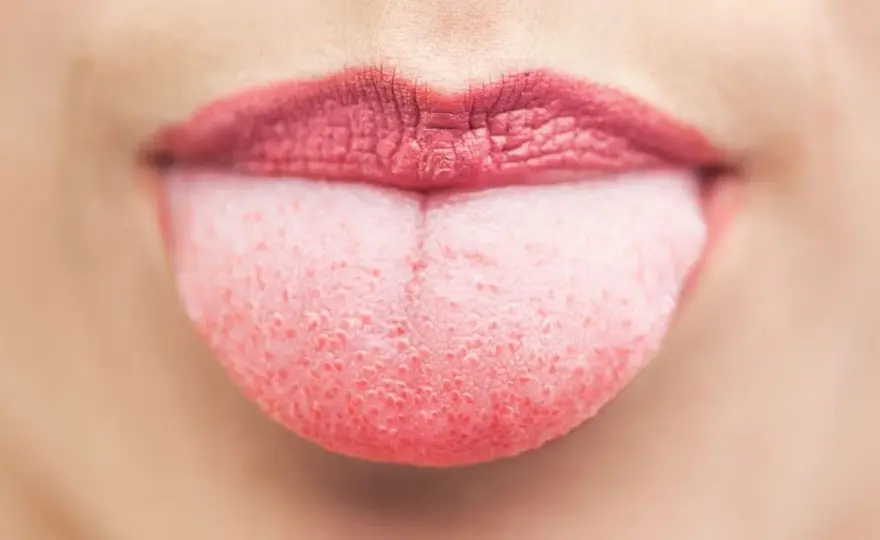Lingua bianca e streptococco - Quando preoccuparsi davvero?