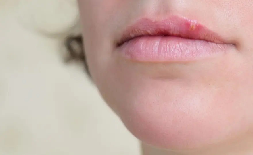 Perché l’herpes ricompare e cosa fare ai primi segnali