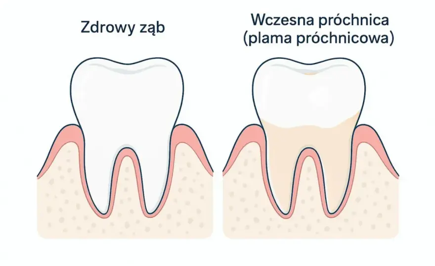 Dziura w zębie - Jak powstaje i kiedy jeszcze da się ją cofnąć?