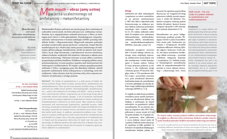 Amfetamina a zęby: Jak rozpoznać i leczyć "meth mouth"?