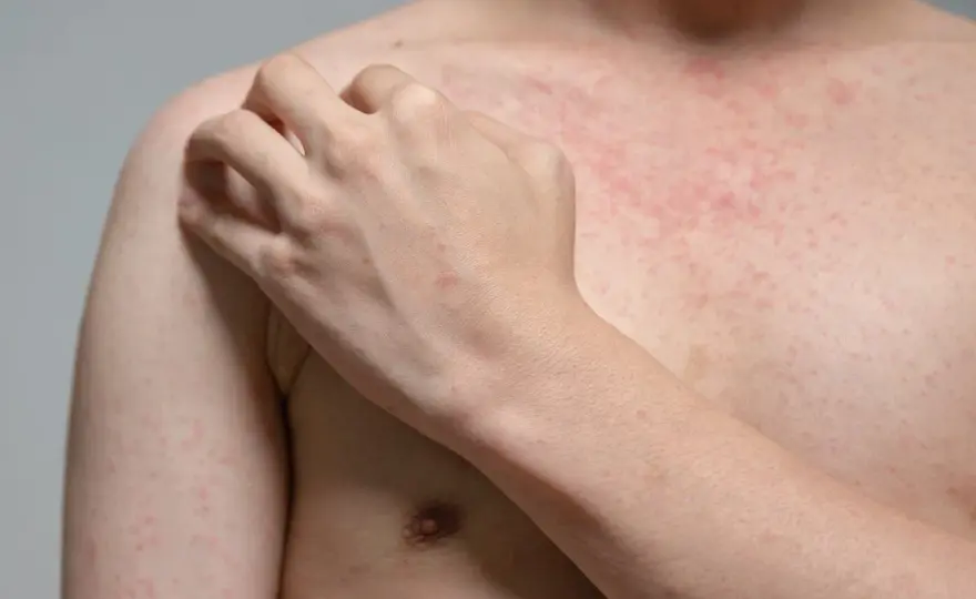 Wysypka w mononukleozie - czy to zawsze alergia?