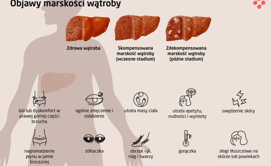 Marskość wątroby - objawy somatyczne. Zobacz, co Ci grozi!
