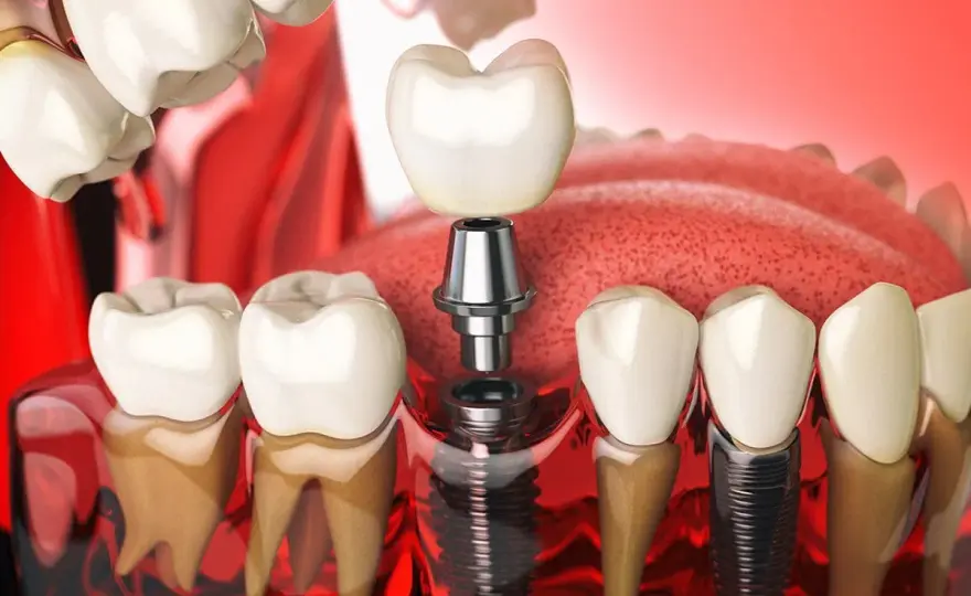 Impianto o perno dente? Guida completa a costi e differenze