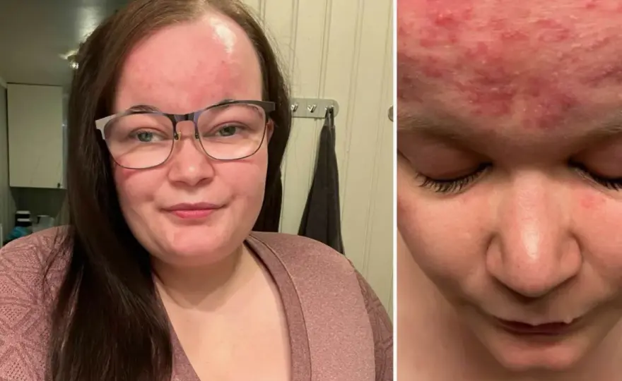 Lindrig rosacea: Känner du igen tecknen? Lugna huden nu!
