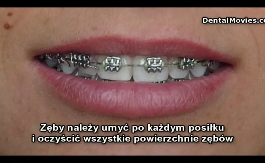 Ile trwa zakładanie aparatu i czy boli? Przewodnik ortodonty