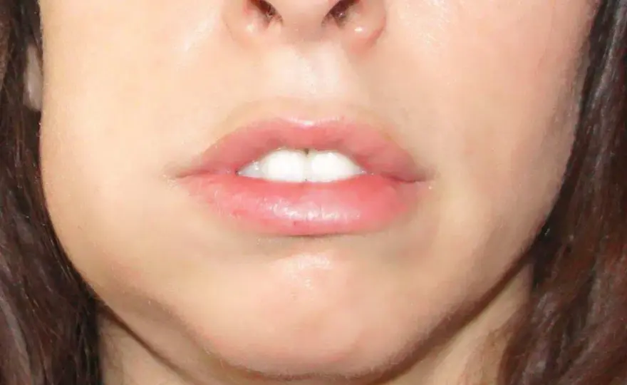 Guancia gonfia - Cause, rimedi e quando correre dal dentista