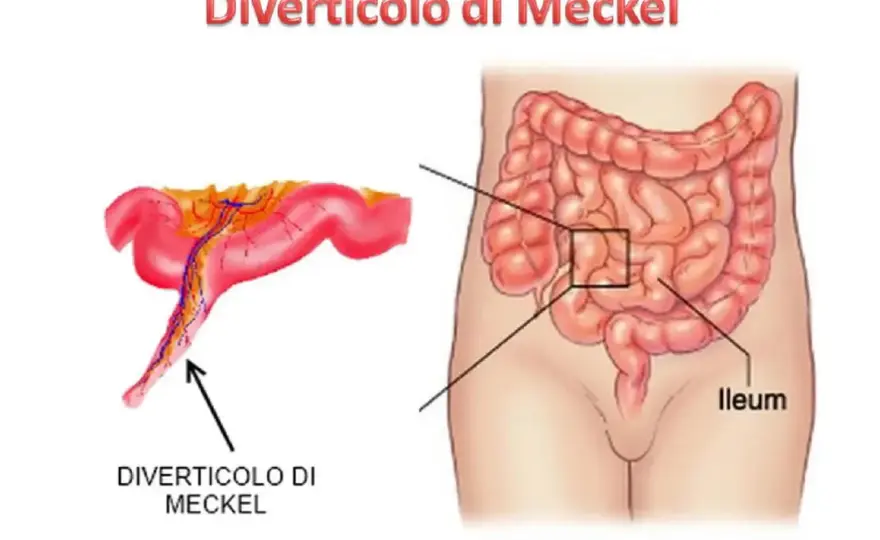 Diverticolo di Meckel nei bambini - sintomi e cura