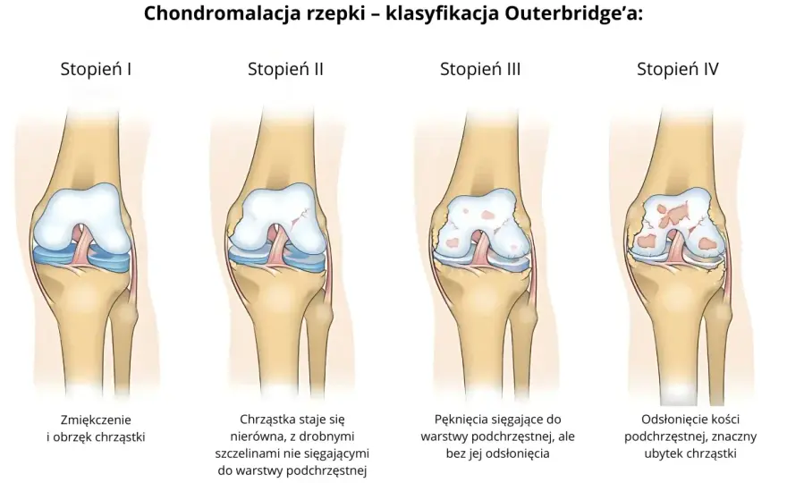 Chondromalacja rzepki - Ruch czy bezruch? Ćwicz bez bólu!