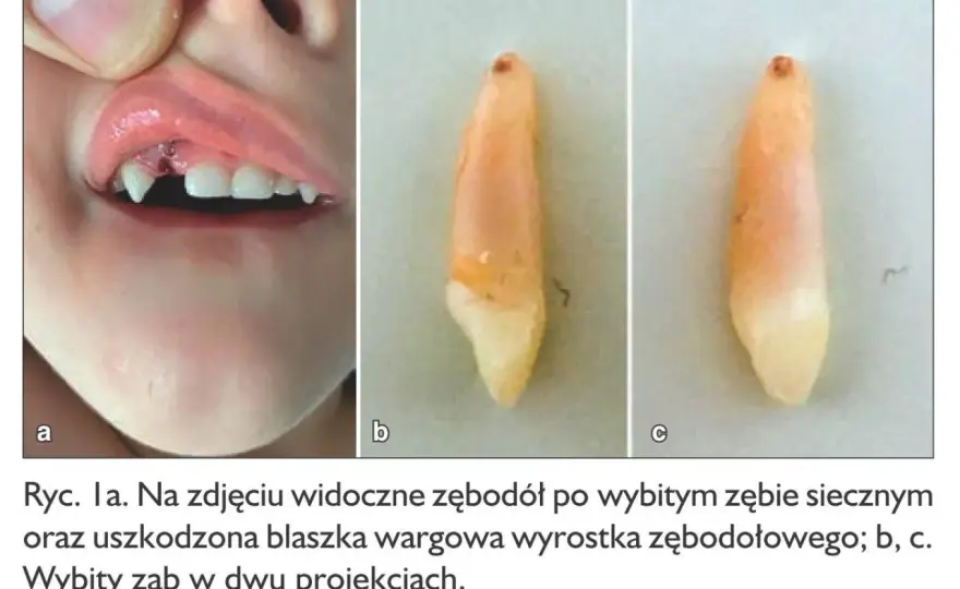 Ruszający się mleczak u 5-latka - Kiedy do dentysty?