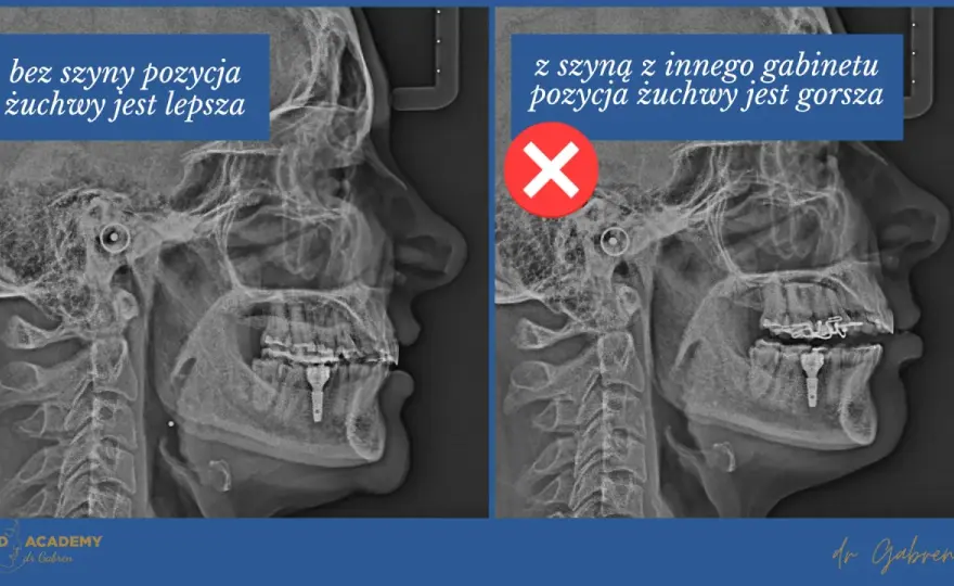 Szyna Michigan przy bruksizmie - jak działa i kiedy ma sens?