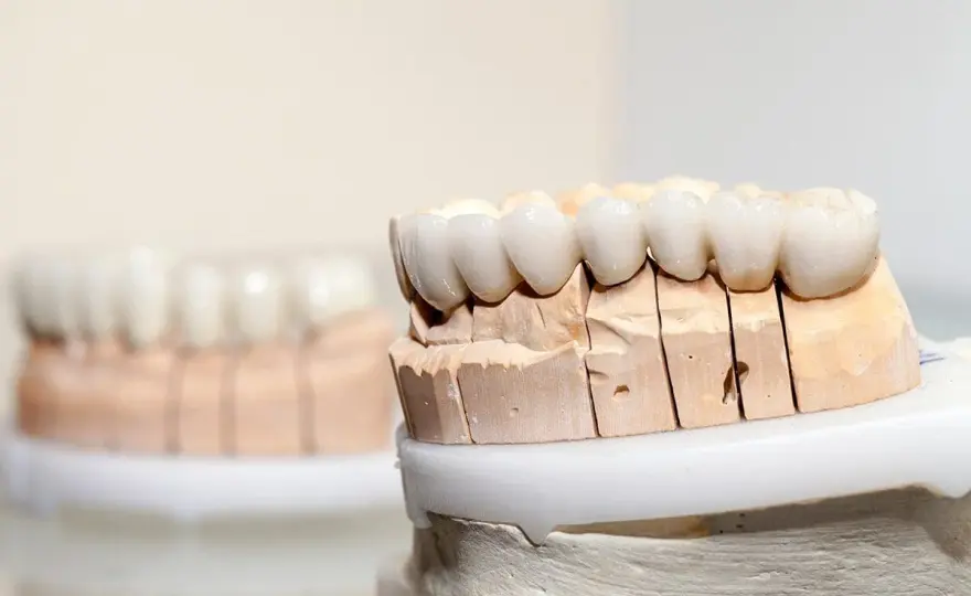 Porcellana dentale - quando scegliere faccette, corone e impianti