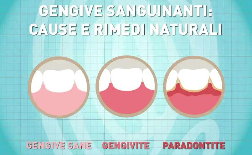 Gengive sanguinanti - Cause e cosa fare subito