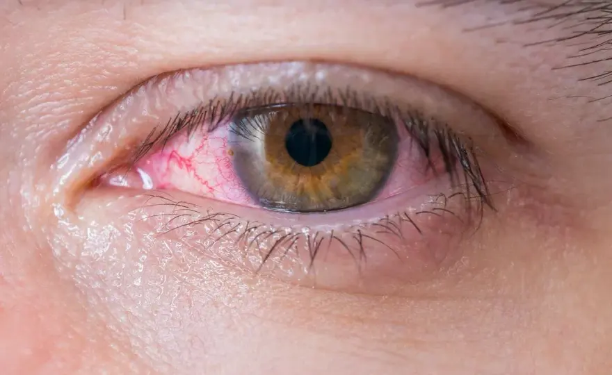 Legañas o conjuntivitis - ¿Cómo distinguirlas en niños?