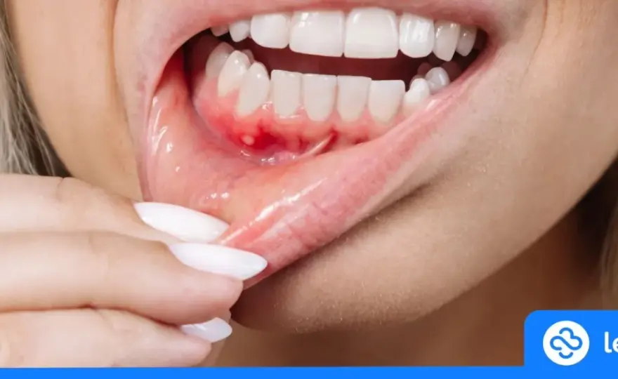 Ropa w dziąśle: Jak sobie pomóc i kiedy pilnie do dentysty?