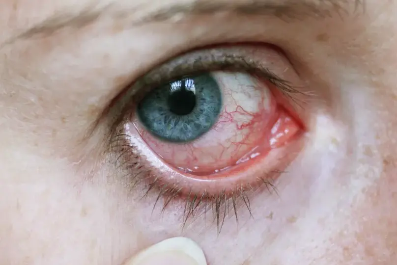 Fibromyalgie Symptome Augen: Unerwartete Beschwerden und Lösungen