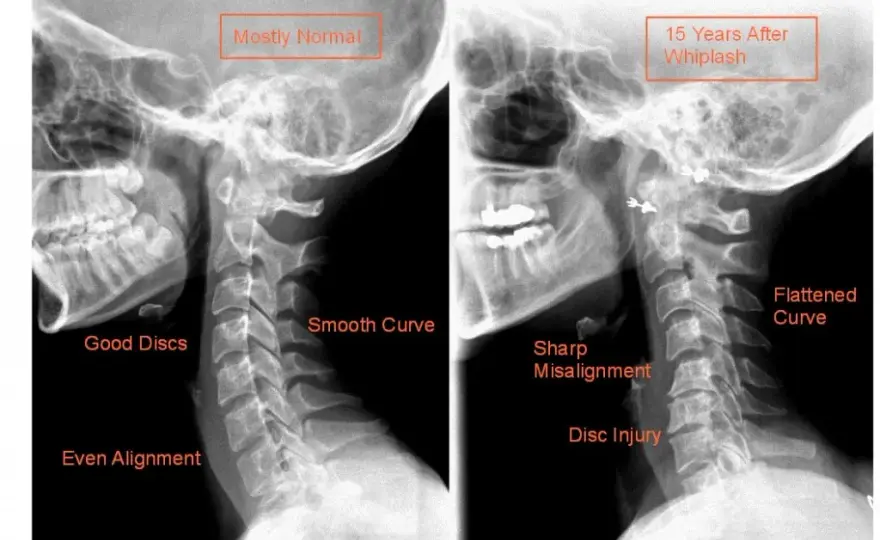 Skręcenie kręgosłupa szyjnego: niebagatelne objawy neurologiczne, które musisz znać