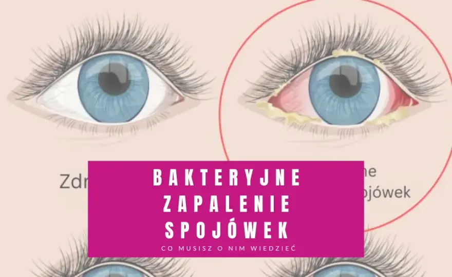 Bakteryjne zapalenie spojówek - jak je rozpoznać i kiedy do lekarza