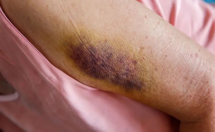 Jambe en sang que faire et quand appeler les secours ?