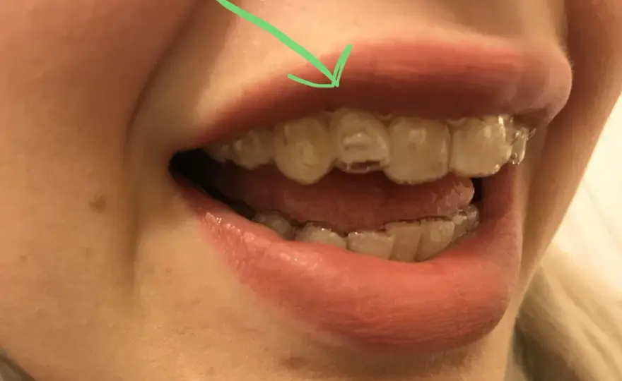 ¿Invisalign no encaja en un diente? Qué hacer
