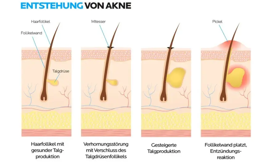 Mitesser verstehen - warum sie entstehen und was hilft