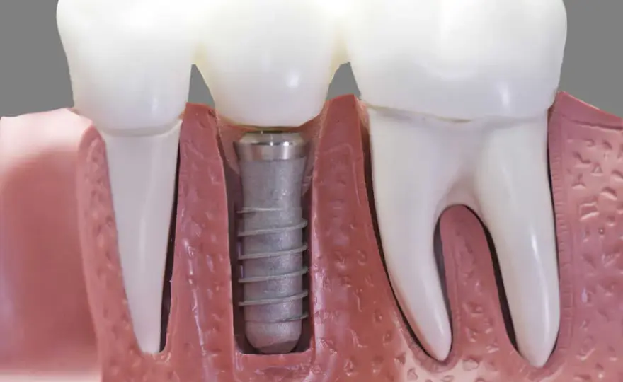 Czy po wszczepieniu implantu zęba można iść do pracy bez obaw?