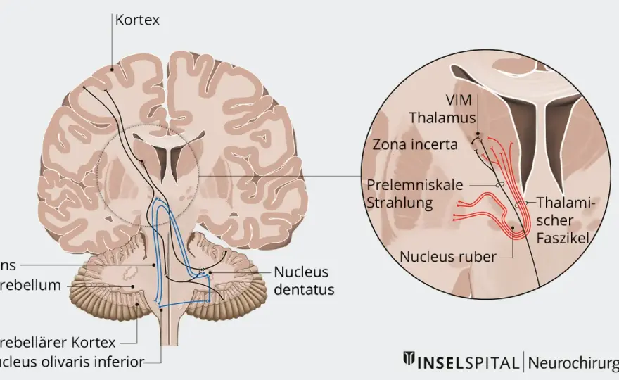 Primidon bei Epilepsie und Tremor - Anwendung, Risiken, Alternativen