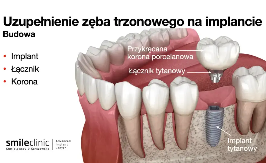 Trzonowce - wszystko, co musisz wiedzieć o tylnych zębach