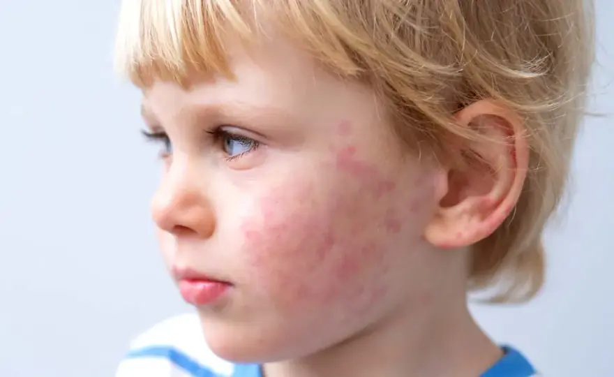 Macchie dopo un alimento nei bambini - allergia alimentare?