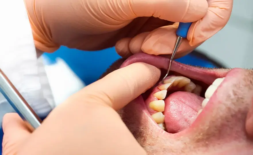 Parodontite rimedi - Cosa funziona davvero per le tue gengive?
