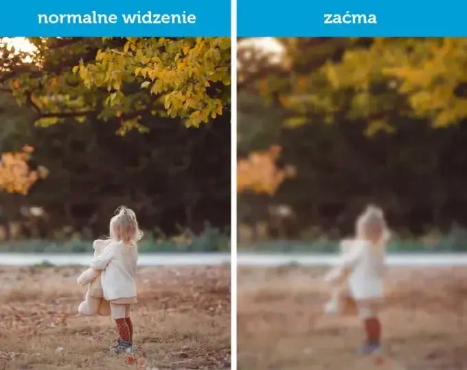 Czy przy zaćmie boli oko? Odkryj prawdę o bólu oczu