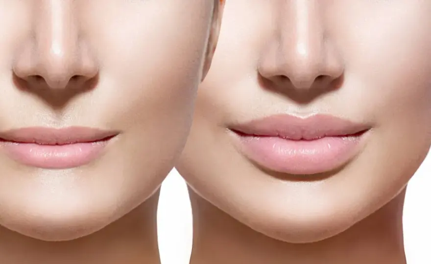 Rughe contorno labbra: acido ialuronico, filler o skincare?