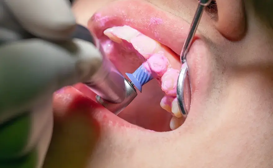 Igiene orale dal dentista - quando farla e quanto costa