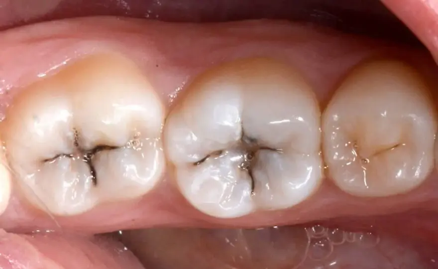 Carie Piccola - Riconoscila, Fermala, Salva il Dente