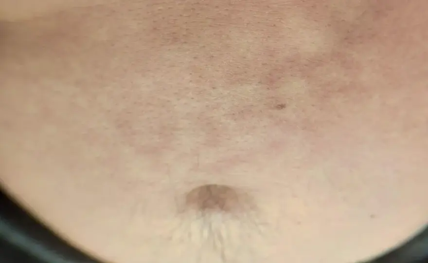 Brązowe plamy na brzuchu - Kiedy do dermatologa?