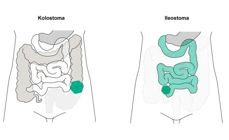 Stomaarten verstehen - Kolostoma, Ileostoma und Urostoma