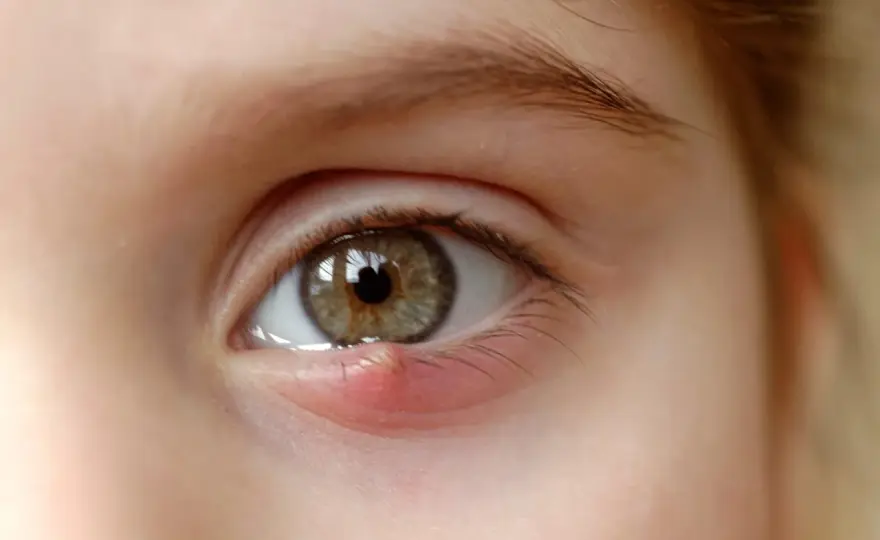 Pus dans les yeux - que faire et quand consulter ?