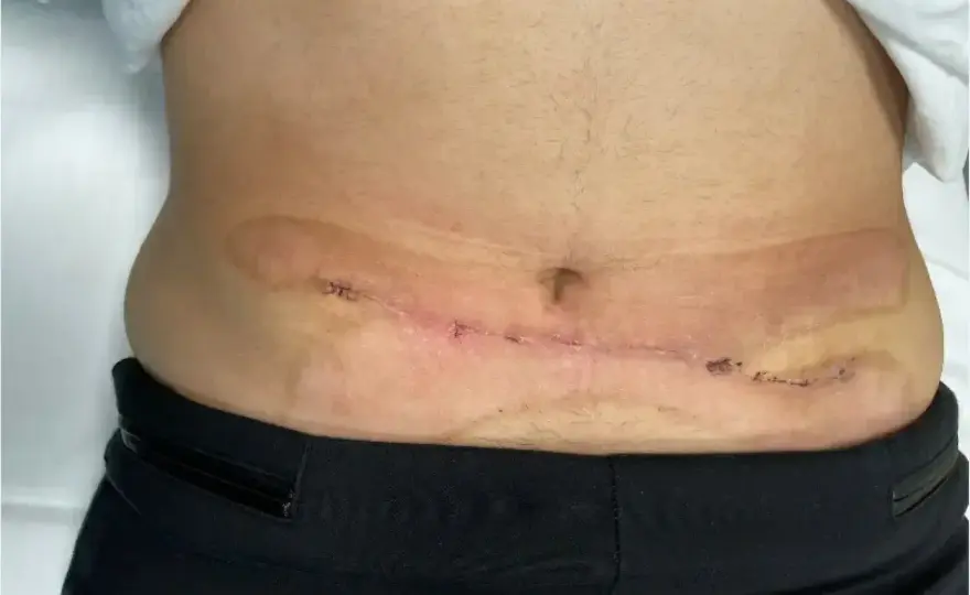 Kriolipoliza po zabiegu - co jest normą, a co powinno niepokoić?