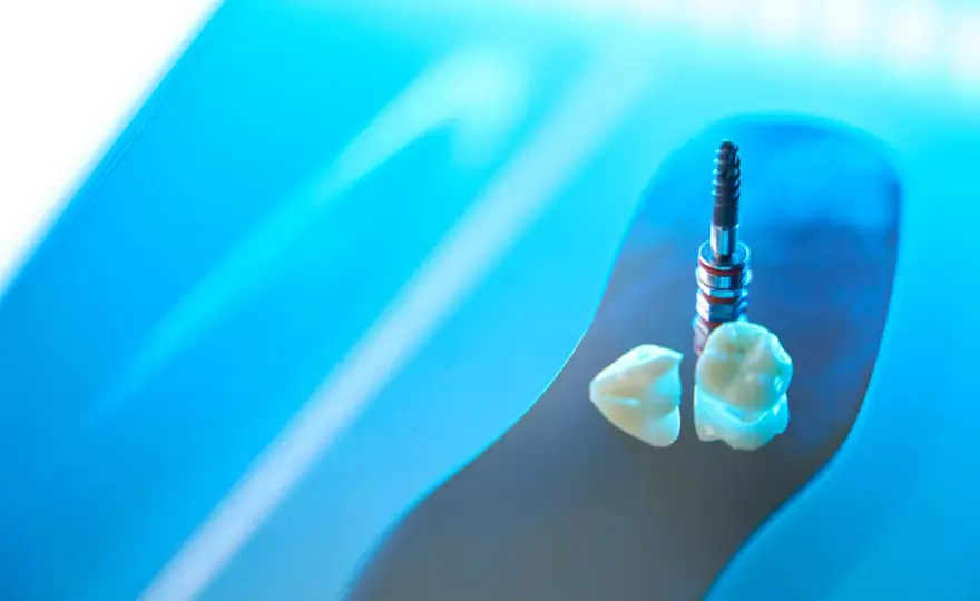 Impianti in zirconia o titanio? Differenze, costi e limiti