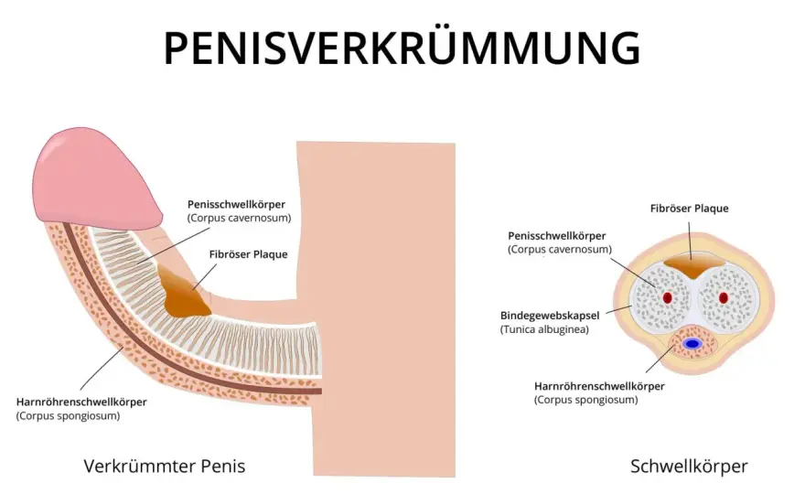 Verdeckter Penis - Ursachen, Diagnose und Behandlung