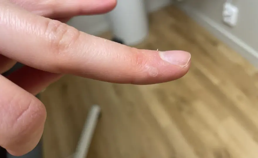 Vårta i handflatan - Känn igen, behandla & när söka vård