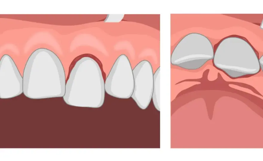 Denti che cadono senza dolore - Cause e cosa fare subito