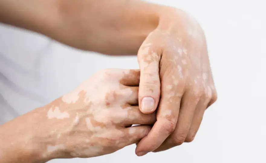 Białe plamy na skórze - Co oznaczają i kiedy do dermatologa?