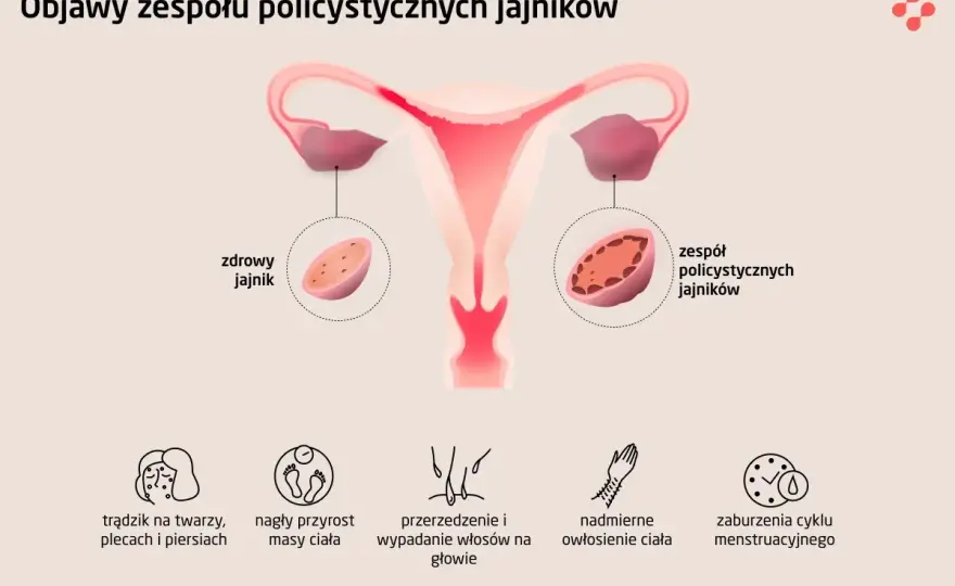 Policystyczne jajniki - Objawy, leczenie i diagnoza. Sprawdź!