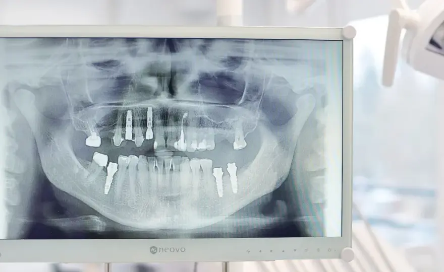 RTG zęba: Co naprawdę widzi dentysta? Ukryta próchnica i torbiele