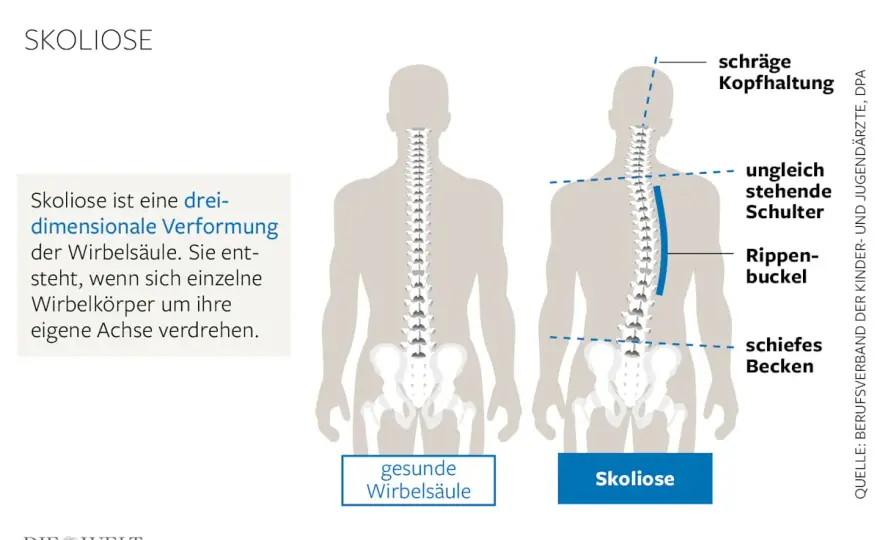 Rippenbuckel: Skoliose erkennen & richtig handeln