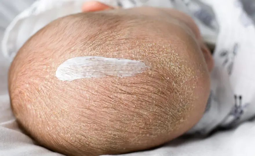 Ciemieniucha u niemowląt - co pomaga i kiedy do pediatry?