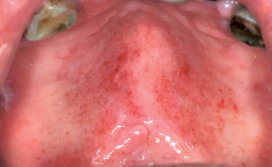 Lesioni della bocca - distinguere afte, herpes e candidosi