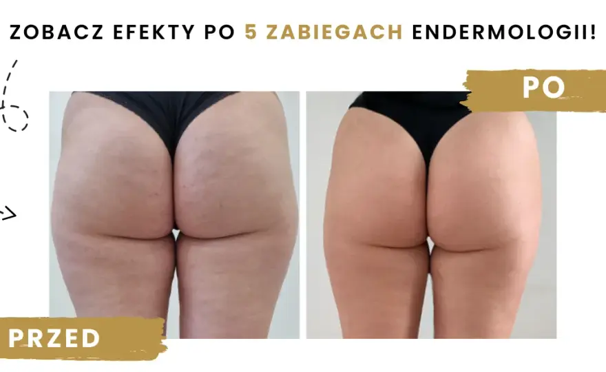 Endermologia: co to, jak działa i czy warto? Pełny przewodnik