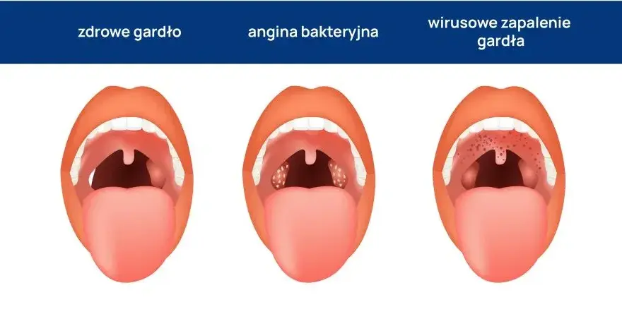 Jak złagodzić ból gardła przy anginie – skuteczne metody i porady