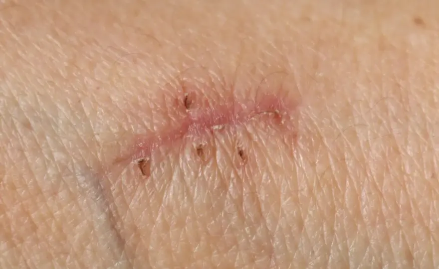 Cicatrice qui s’ouvre et saigne - que faire ?